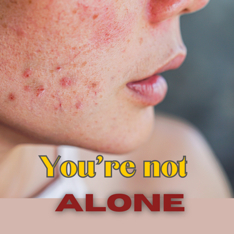 Acne and Self-Confidence